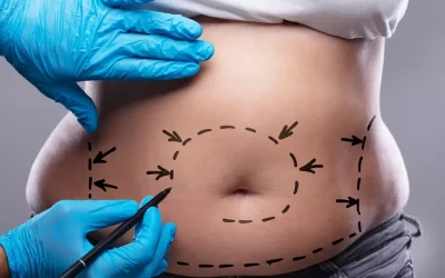 جراحة شدّ البطن